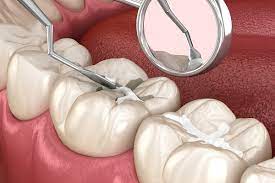Applying dental sealants